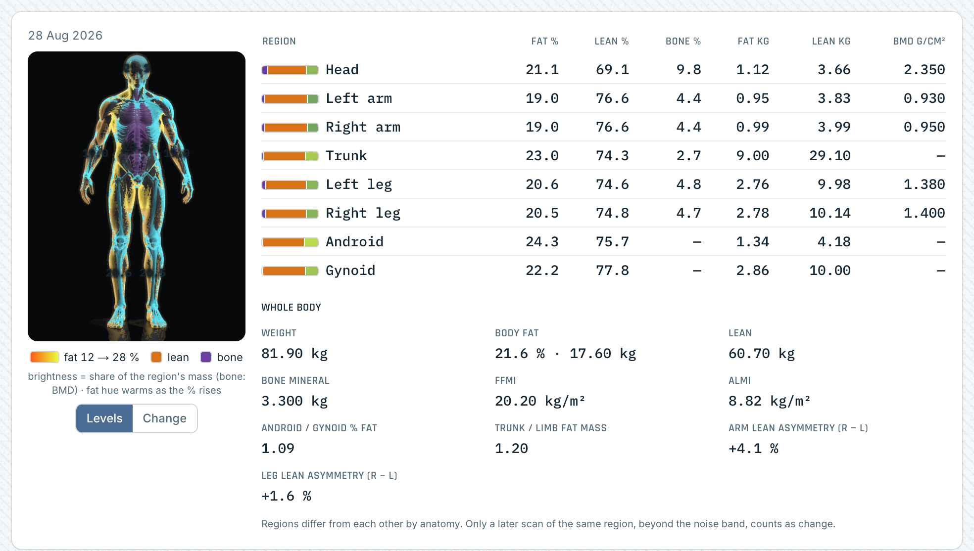 Regional body figure from a DEXA scan in the light theme, with the eight-region fat, lean and bone table (demo data)