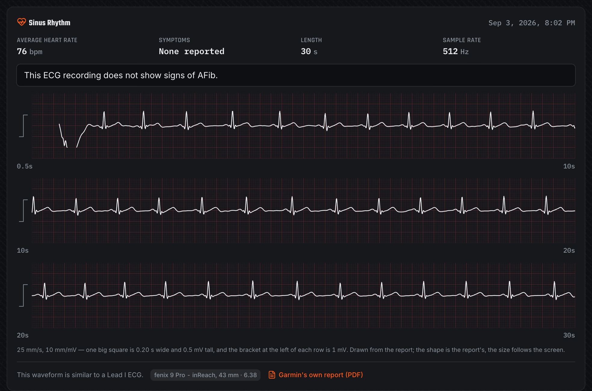 Three ECG strips redrawn from an imported Garmin ECG PDF, with the classification and average heart rate above them